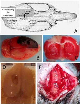 Feasibility of Human Neural Stem Cell Transplantation for the Treatment of Acute Subdural Hematoma in a Rat Model: A Pilot Study